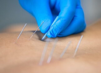 Physical Therapists’ Dry Needling Bill AB 2497 Defeated on California Assembly Floor