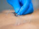 Physical Therapists’ Dry Needling Bill AB 2497 Defeated on California Assembly Floor