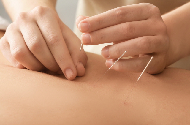 Young man getting acupuncture treatment, closeup