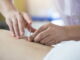 Acupuncture Treatment for the Side Effects of Chemotherapy